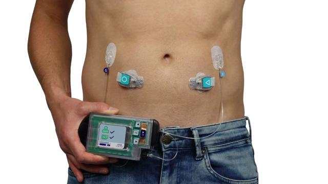 Kunstalvleesklier van Inreda op lichaam