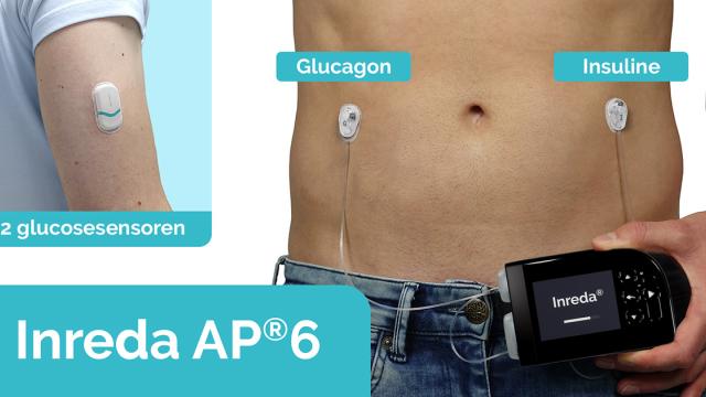 Prototype Inreda kunstalvleesklier in hand van persoon met diabetes met blote buik met sensoren erop