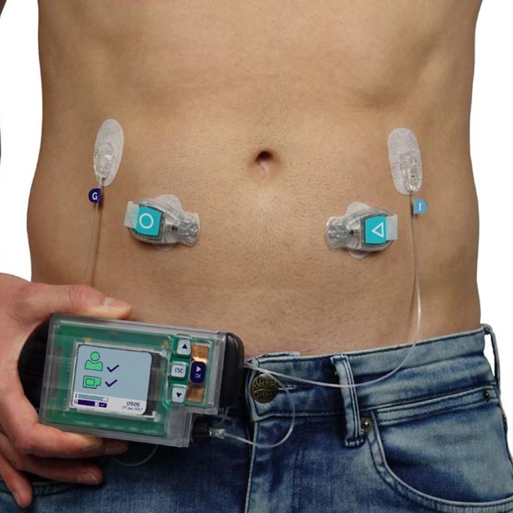 Kunstalvleesklier van Inreda op lichaam