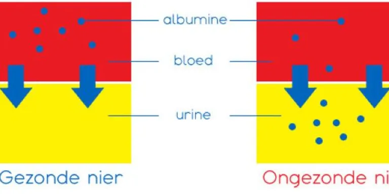 Infographic van Albumine, in een gezonde nier zit er geen albumine in de urine